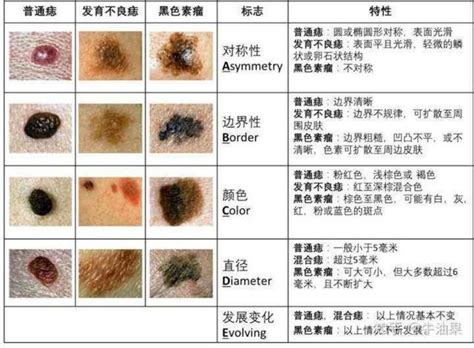 身體痣的好壞|痣是什麼？會變成黑色素瘤？7種一定要除的痣